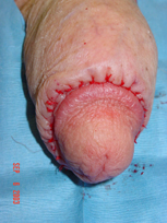 Penile Revisonary Surgery - Penis Enlargement