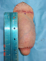 Penile Revisonary Surgery - Penis Enhancement
