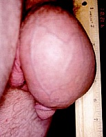 Penile Revisonary Surgery - Before Penis Enhancement