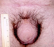Penile Revisonary Surgery - Phalloplasty