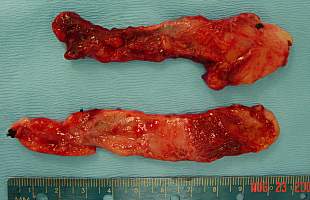 Penile Revisonary Surgery - Penile Dermal Fat Graft Strips
