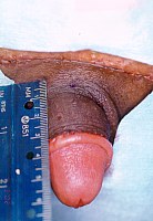 Penile lengthening to correct a buried penis.