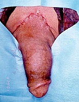 Penile Revisonary Surgery - Penile Enhancement